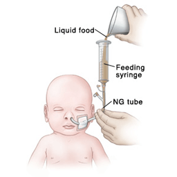 Pediatric feeding tube